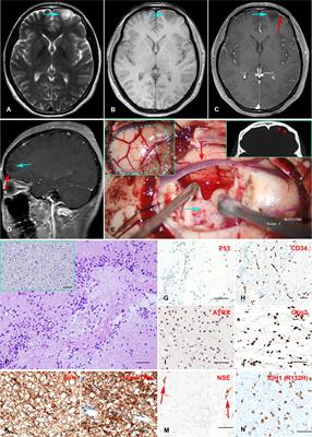 Case Report: A novel LHFPL3::NTRK2 fusion in dysembryoplastic neuroepithelial tumor
